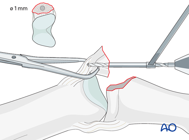 Lag-screw fixation of middle phalangeal base fracture; lateral PIP deviation; drill gliding hole; prevent fragment rotation.