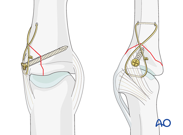 Lag-screw fixation of middle phalangeal base fracture; small fragment; strengthen with figure-of-eight wire loop; compression aid.