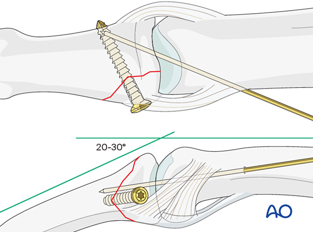 Lag-screw fixation of middle phalangeal base fracture; joint transfixation; K-wire for stability; protect with splint.