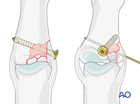 Lateral joint reconstruction of a multifragmentary articular fracture of the middle phalangeal base