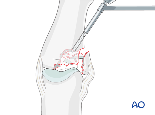 Joint reconstruction of lateral plateau fracture in middle phalangeal base, using 1.5 mm drill bit for disimpaction.