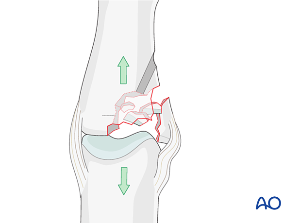 Joint reconstruction of lateral plateau fracture in middle phalangeal base, direct reduction needed, bone graft support.