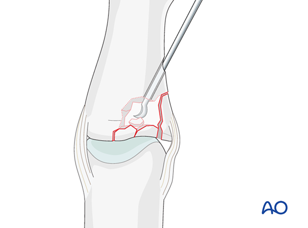 Joint reconstruction of lateral plateau fracture in middle phalangeal base, disimpact fragments using K-wire or dental pick.