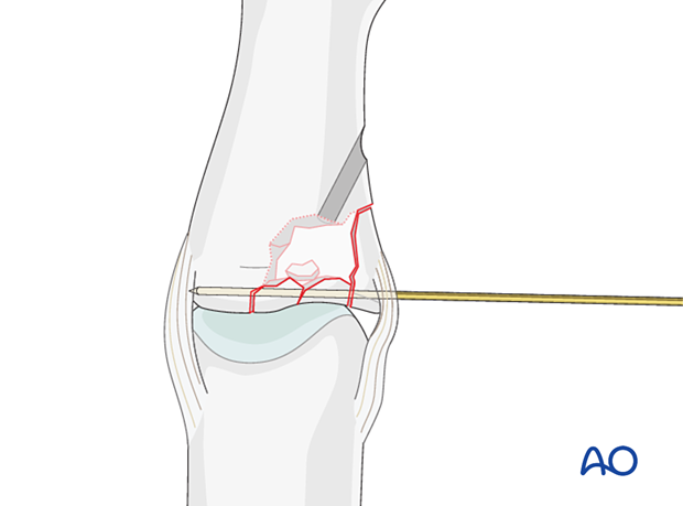 Joint reconstruction of lateral plateau fracture in middle phalangeal base, optional K-wire for stabilization until consolidation.