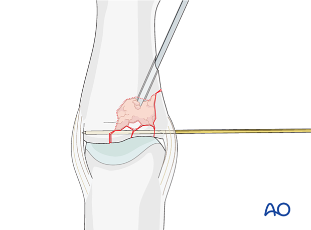 Reconstruction of a lateral plateau fracture in the middle phalangeal base with bone graft