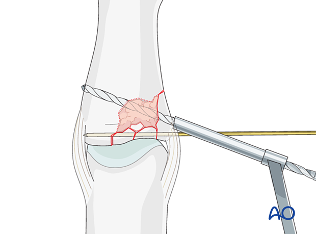 Joint reconstruction of lateral plateau fracture in middle phalangeal base, use position screw or K-wire, drill threaded hole.