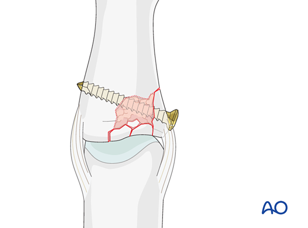 Joint reconstruction of lateral plateau fracture in middle phalangeal base, insert screw, tighten to hold reduction, check congruity.