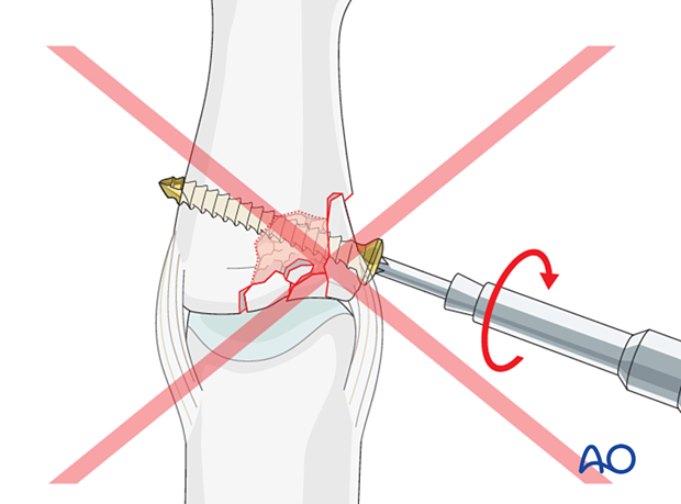 Joint reconstruction of lateral plateau fracture in middle phalangeal base, avoid lag screw, do not overtighten screw.