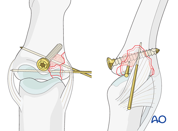 Joint reconstruction of lateral plateau fracture in middle phalangeal base, use antiglide plate, avoid fragmenting bone.