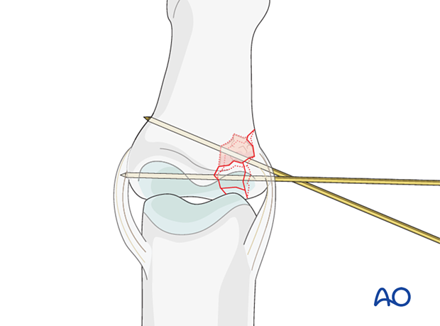 Joint reconstruction of lateral plateau fracture in middle phalangeal base, stabilize lateral fragment with K-wires.