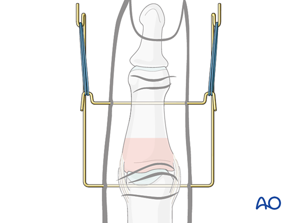 Joint reconstruction of lateral plateau fracture in middle phalangeal base, add dynamic external fixator for 4 weeks for early mobilization.