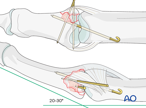 Joint reconstruction of lateral plateau fracture in middle phalangeal base, transfix PIP joint with K-wire, remove after 3–4 weeks.