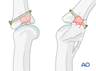 Central joint reconstruction of a multifragmentary articular fracture of the middle phalangeal base