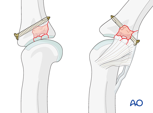 Joint reconstruction of central impaction fracture in middle phalangeal base, use bone graft, subchondral screw, antiglide plate.