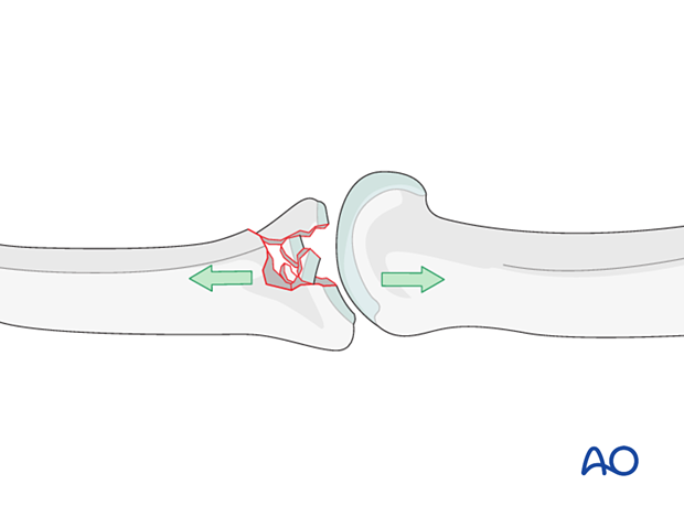 Joint reconstruction of central impaction fracture in middle phalangeal base, direct reduction needed, restore joint surface, support with bone graft.