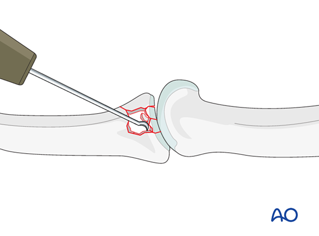 Joint reconstruction of central impaction fracture in middle phalangeal base, use K-wire or dental pick to restore congruity, reduce degenerative risk.