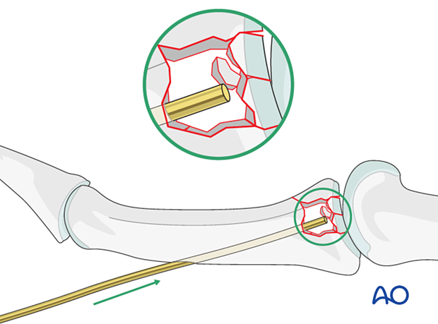 Joint reconstruction of central impaction fracture in middle phalangeal base, optional K-wire through shaft to subchondral region.
