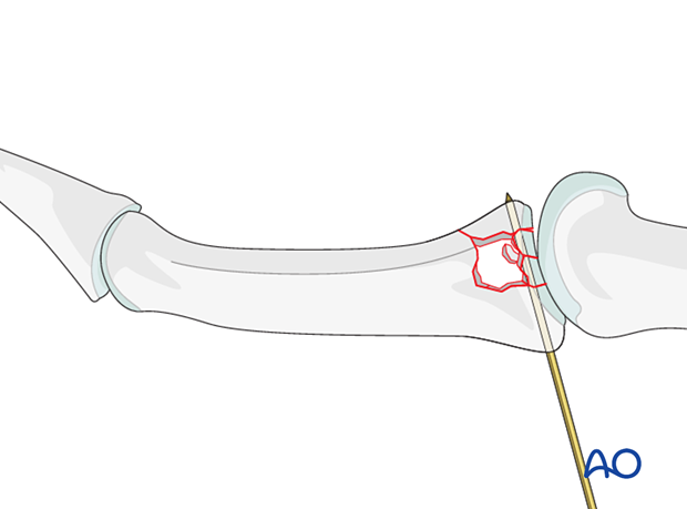 Joint reconstruction of central impaction fracture in middle phalangeal base, insert K-wires dorsal to palmar, avoid neurovascular damage.