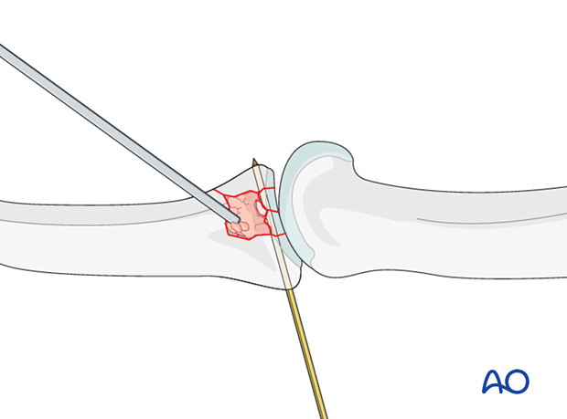 Insertion of bone graft in a comminuted articular fracture of the middle phalangeal base