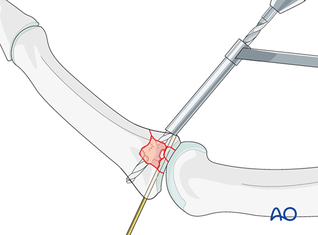 Joint reconstruction of central impaction fracture in middle phalangeal base, use position screw or K-wire, drill threaded hole.