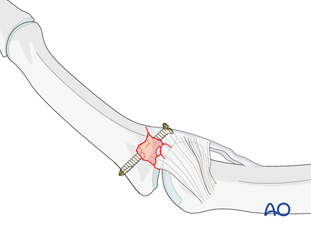 Joint reconstruction of central impaction fracture in middle phalangeal base, insert screw, tighten to hold reduction, check congruity.