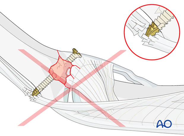 Joint reconstruction of central impaction fracture in middle phalangeal base, avoid long screw to prevent extensor tendon damage.