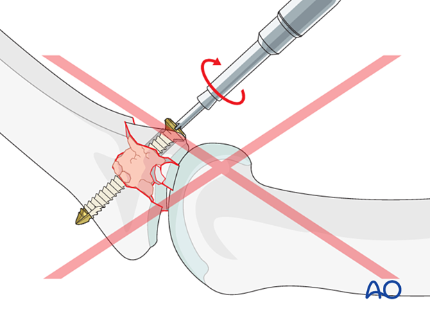 Joint reconstruction of central impaction fracture in middle phalangeal base, avoid lag screw, do not overtighten screw.