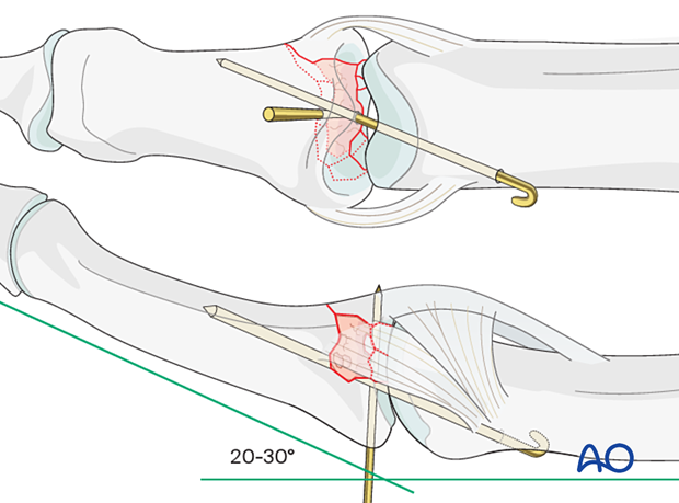 Joint reconstruction of central impaction fracture in middle phalangeal base, transfix PIP joint with K-wire, remove after 3–4 weeks.
