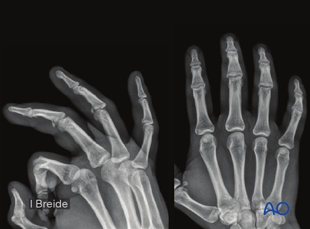 Joint reconstruction of central impaction fracture in middle phalangeal base, AP and oblique x-ray of 3rd and 4th finger.
