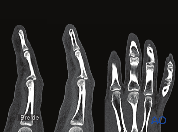 Joint reconstruction of central impaction fracture in middle phalangeal base, CT scan of the same case.