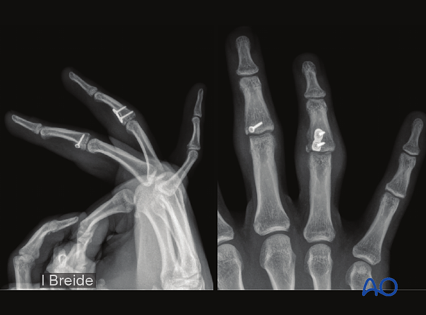 Joint reconstruction of middle phalangeal base fracture, postoperative x-ray after screw stabilization and plating.