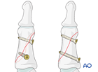 Lag-screw fixation of an oblique fracture of the middle phalanx