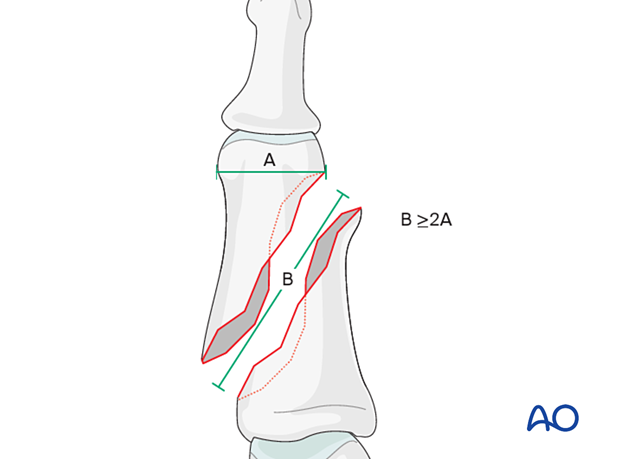 Lag-screw fixation of long oblique shaft fracture, fracture line should be at least twice the diameter of diaphysis.