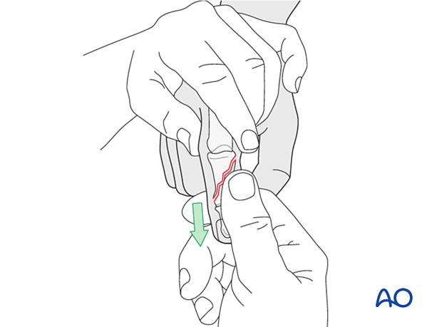Lag-screw fixation of long oblique shaft fracture, reduction by traction and flexion, confirm with image intensifier.