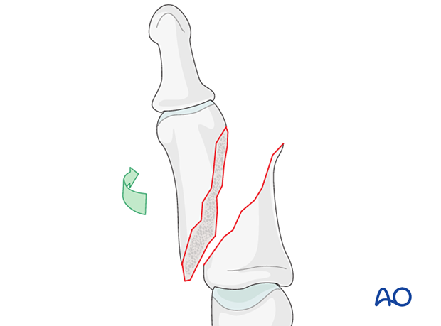 Lag-screw fixation of middle phalanx fracture; rotate finger, open fracture, irrigate zone, determine fracture geometry.