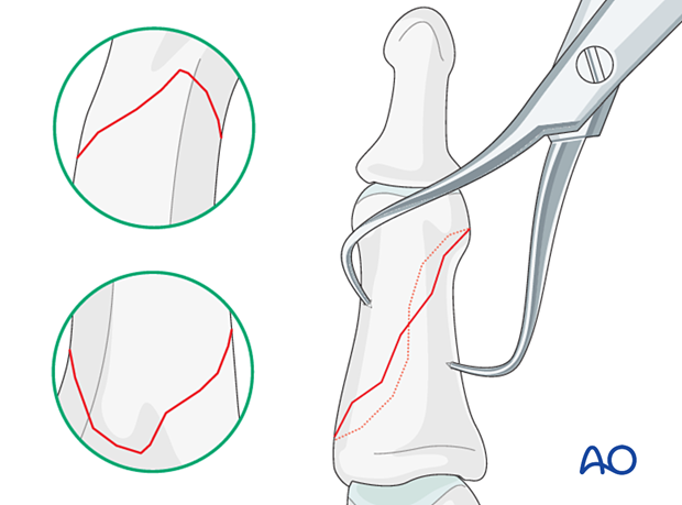 Lag-screw fixation of middle phalanx fracture; gently reduce fracture with forceps, confirm reduction, avoid malrotation.