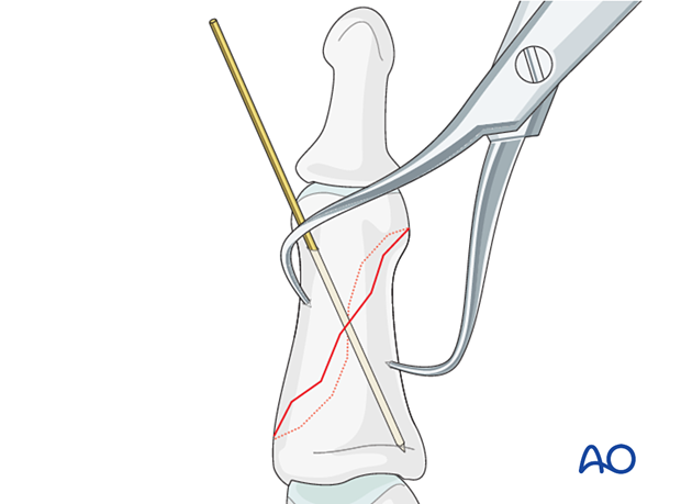 Lag-screw fixation of middle phalanx fracture; hold reduction with K-wires or forceps, avoid planned screw paths.