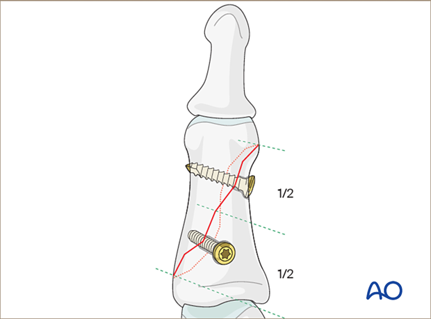 Lag-screw fixation of middle phalanx fracture; insert two screws, equally spaced.