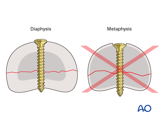Lag-screw fixation of middle phalanx fracture; avoid countersinking screws in metaphysis to prevent loss of purchase and compression.