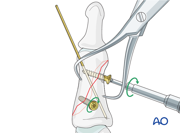 Lag-screw fixation of middle phalanx fracture; insert screws perpendicular, tighten alternately, avoid fragment displacement.
