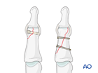 Lag-screw fixation of a partial articular fracture of the middle phalangeal head
