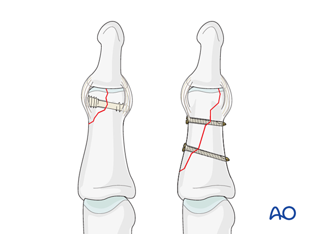 Lag-screw fixation of partial articular fracture, showing screw placement through nonarticular face and DIP joint flexion.