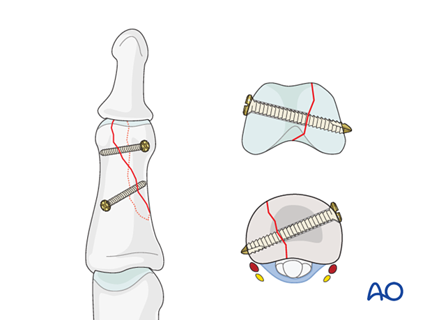 Lag-screw fixation of partial articular fracture, showing screw insertion perpendicular to fracture plane, confirmed with radiographic views.
