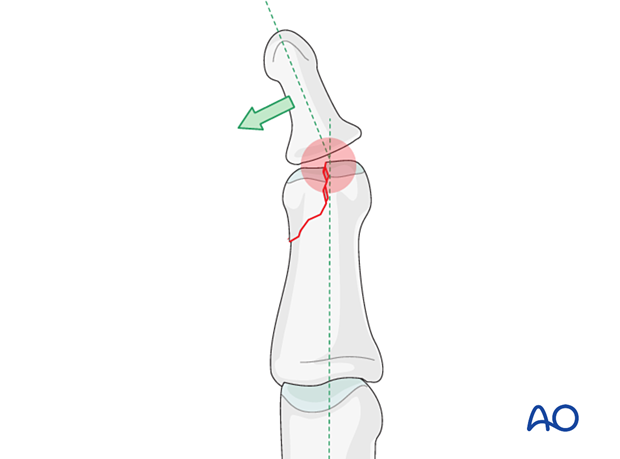 Lag-screw fixation of partial articular fracture, showing risks of cartilage damage, degenerative disease, and finger angulation.