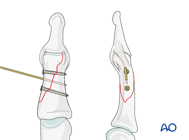 Lag-screw fixation of middle phalangeal head fracture. Place screws proximal to collateral ligament in large fragments.