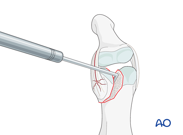Lag-screw fixation of middle phalangeal head fracture. Use dental pick to explore and reduce fragments. Maintain vascularity to avoid osteonecrosis.