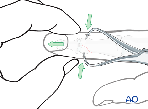 Lag-screw fixation of middle phalangeal head fracture. Traction restores length. Lateral pressure reduces fracture. Confirm with image intensifier.