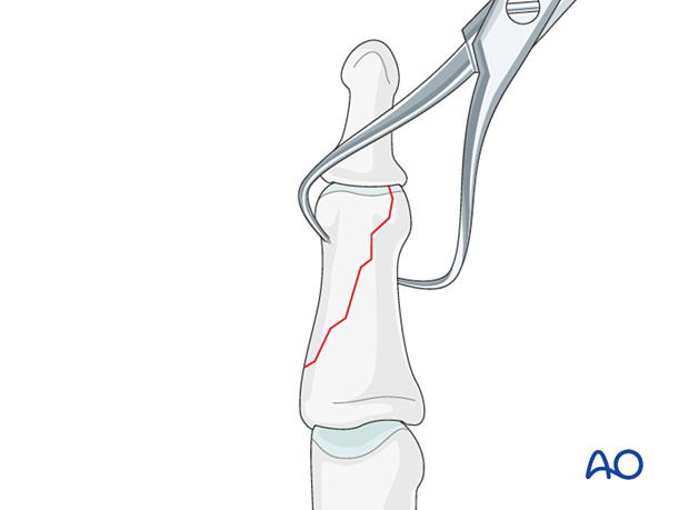 Lag-screw fixation of middle phalangeal head fracture. Use pointed forceps to rock larger fragments. Confirm reduction with image intensification.