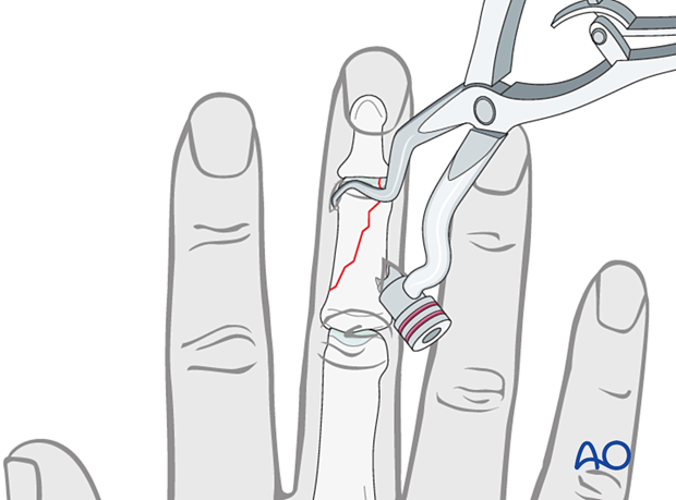 Lag-screw fixation of middle phalangeal head fracture. Use reduction forceps for percutaneous technique. Avoid soft tissue impingement.