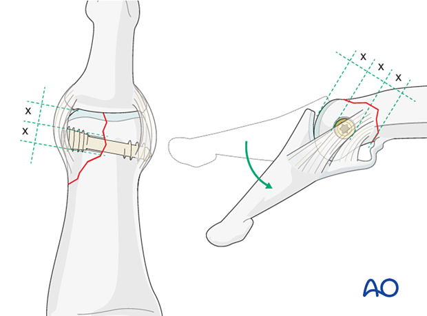 Lag-screw fixation of middle phalangeal head fracture. Screw length must penetrate opposite cortex. Ensure minimal distance between screw head and fracture line. Choose smaller diameter screw if needed.